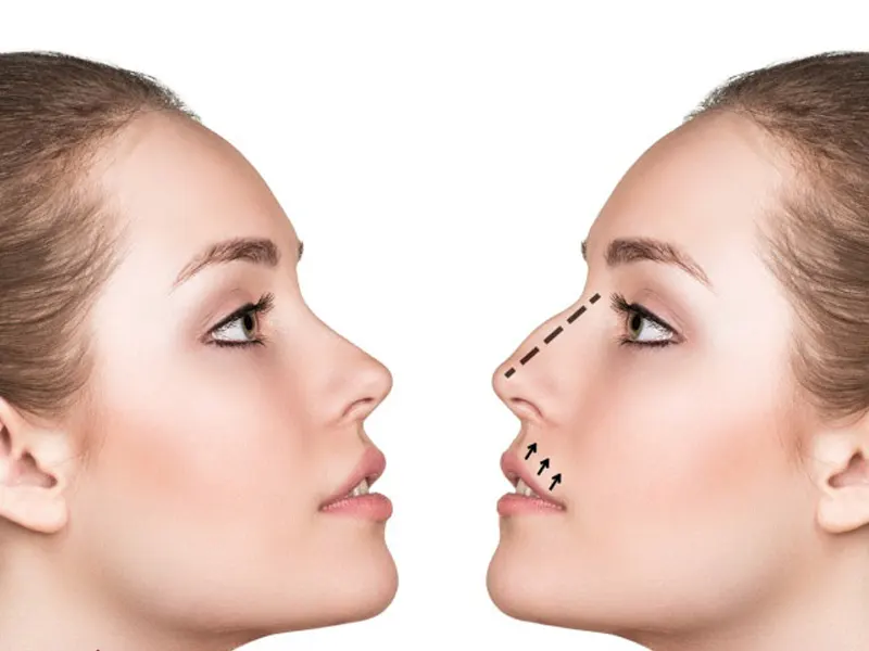 تفاوت جراحی بینی به روش باز یا بسته