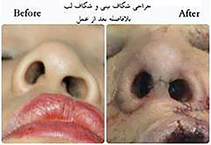 cleft nose 1