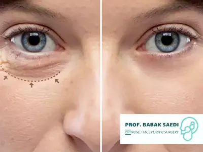 بهترین سن جراحی بلفاروپلاستی