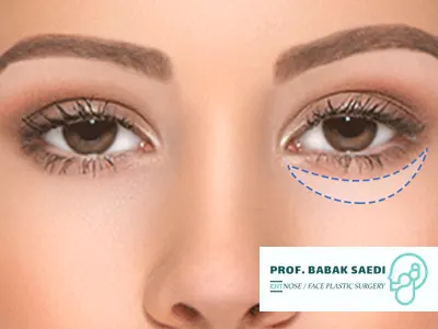 حداقل سن جراحی پلک