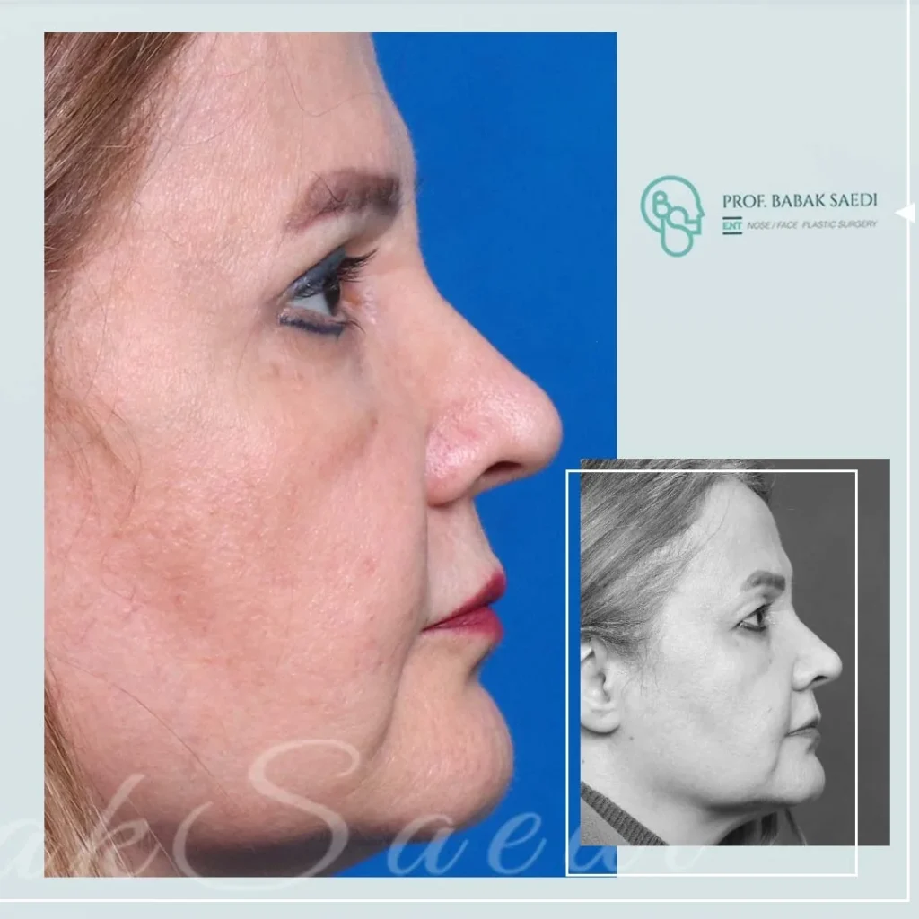 نمونه کار بلفاروپلاستی دکتر بابک ساعدی 2