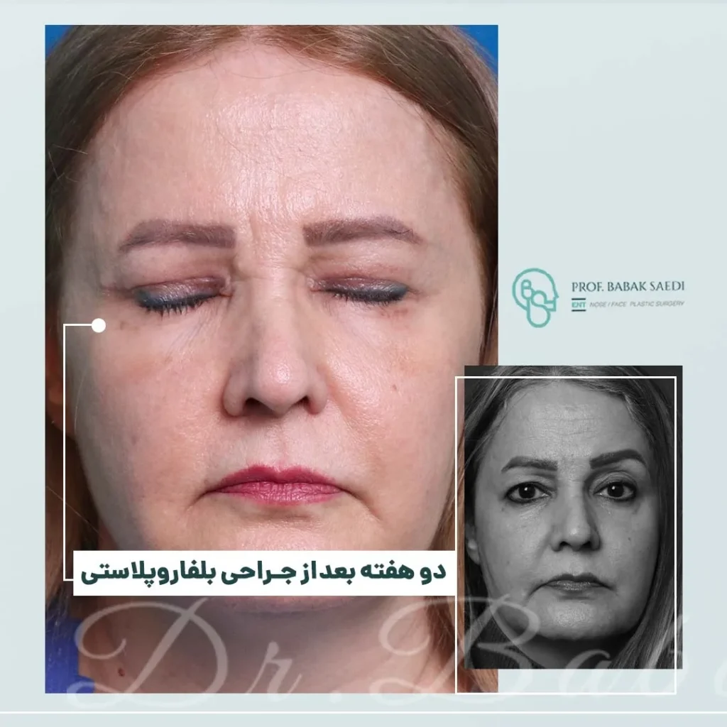 نمونه کار بلفاروپلاستی دکتر بابک ساعدی 1