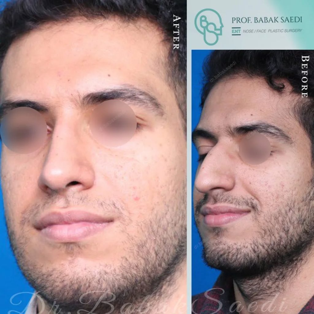 قبل و بعد عمل بینی مردانه دکتر بابک ساعدی