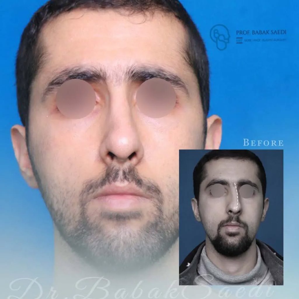 نمونه کار عمل بینی مردانه دکتر بابک ساعدی