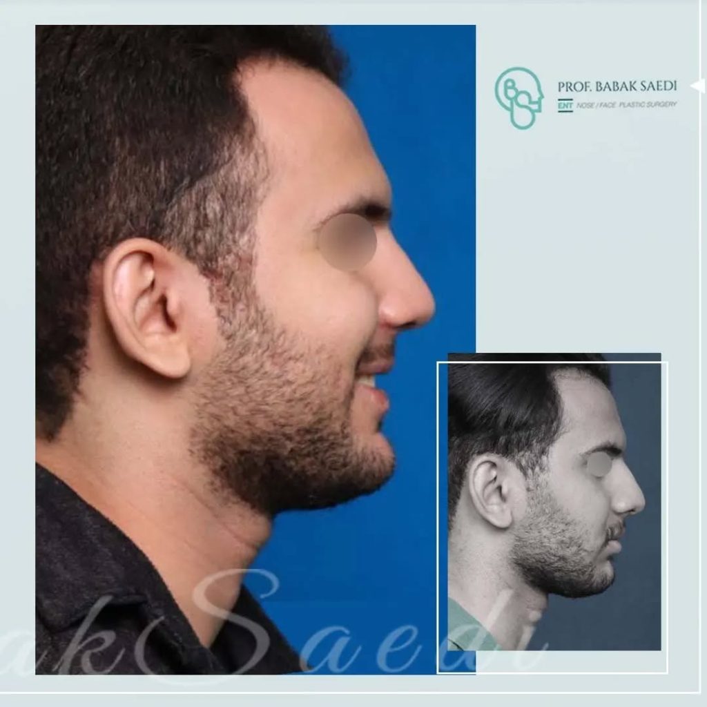 نمونه کار عمل بینی گوشتی دکتر بابک ساعدی