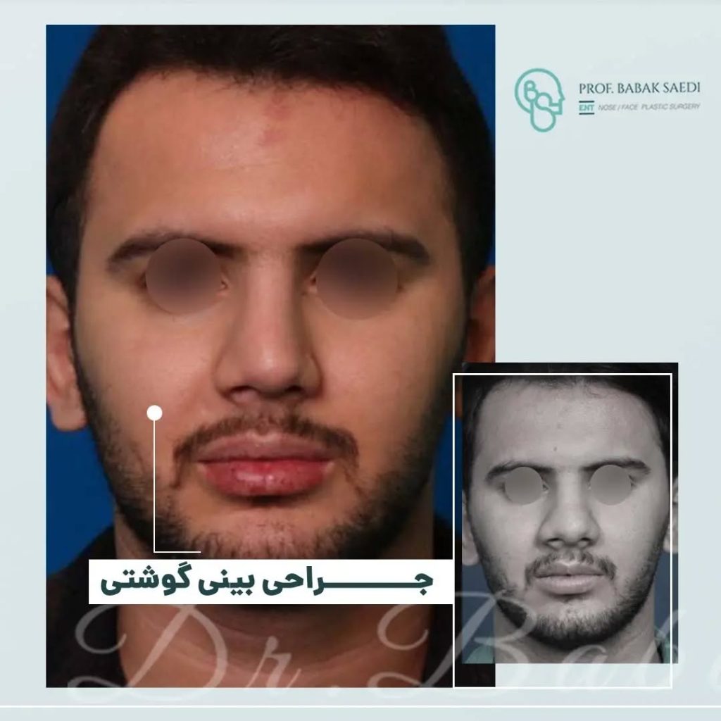 نمونه کار جراحی بینی گوشتی دکتر بابک ساعدی