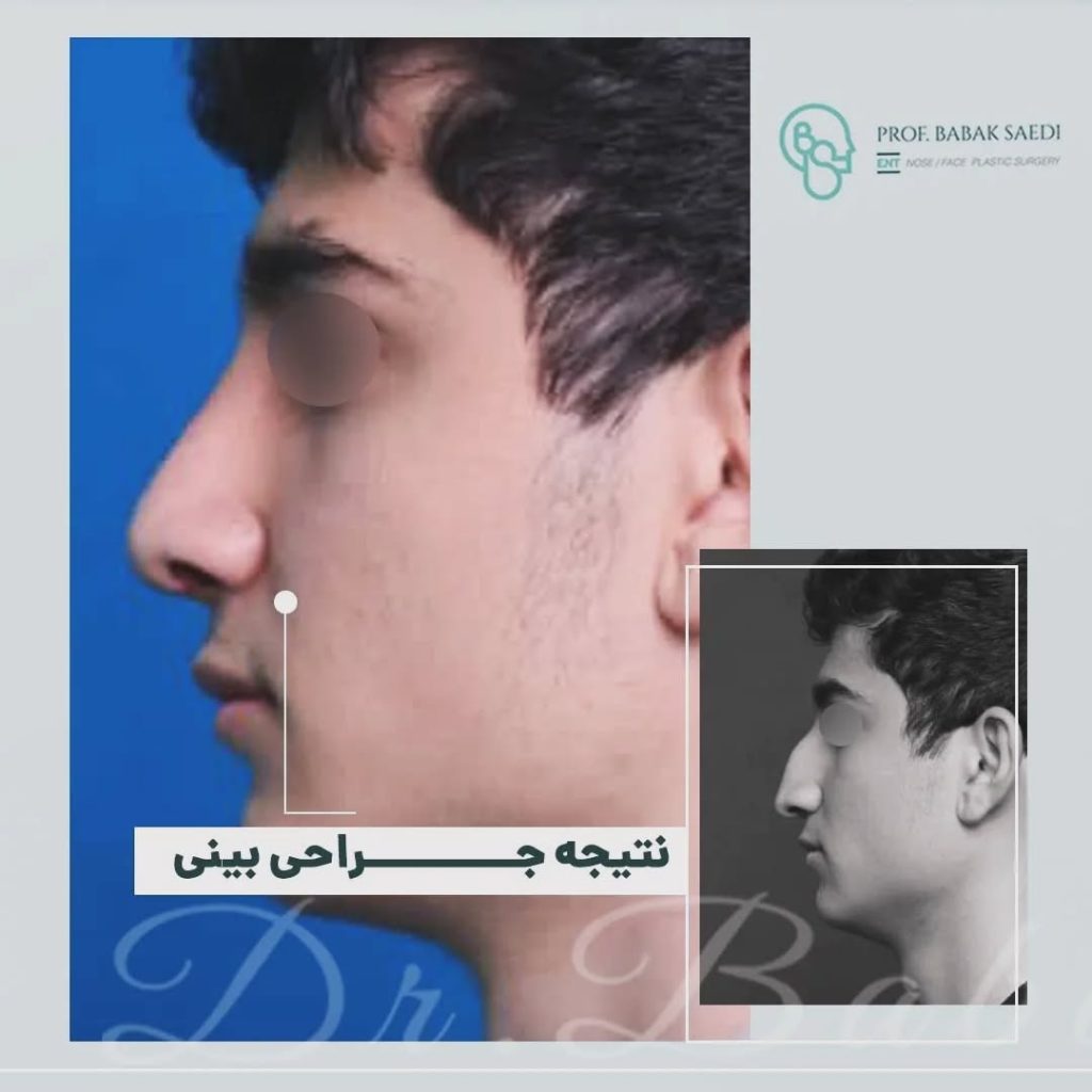 نمونه عمل بینی مردانه دکتر بابک ساعدی