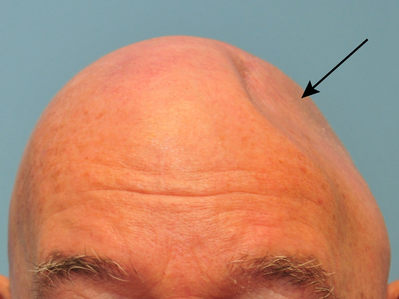 کرانیوپلاستی چیست؟ - دکتر بابک ساعدی