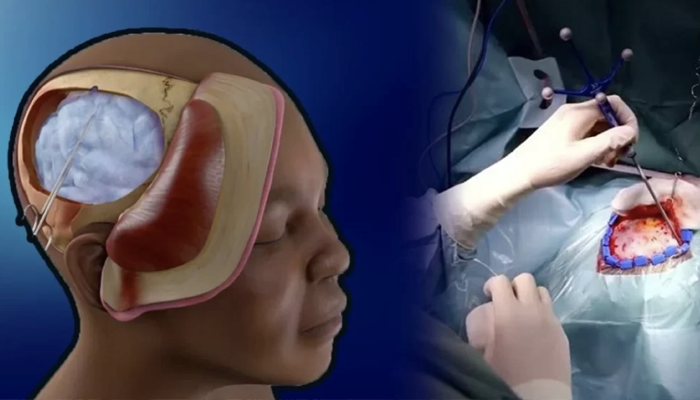 خطرات و عوارض احتمالی جراحی جمجمه