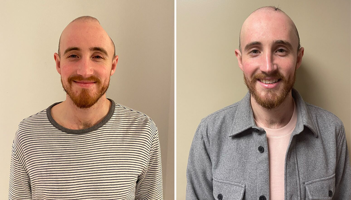 دلایل انجام کرانیوپلاستی - عکس قبل و بعد