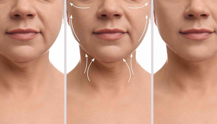 علائم و روند تشخیص نیاز به لیفت گردن