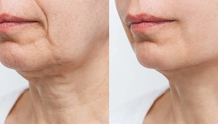 چه کسانی بهترین کاندید برای لیفت گردن هستند؟