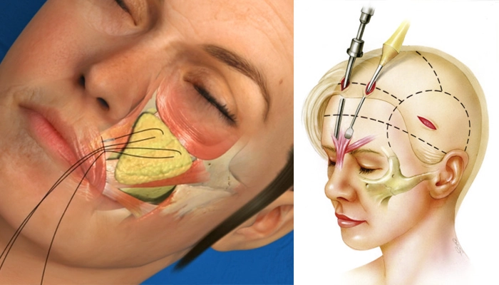 مراحل انجام لیفت آندوسکوپی صورت