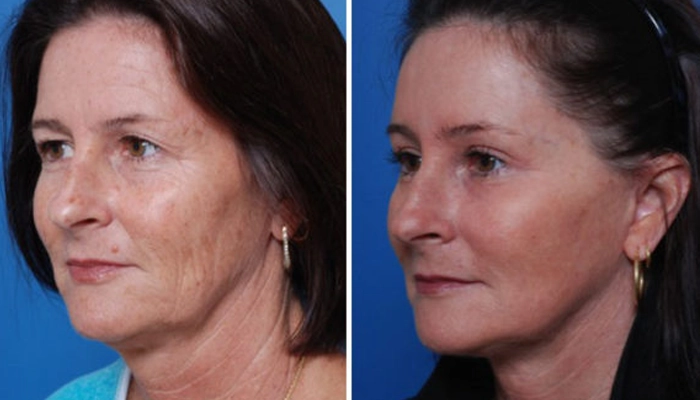 قبل و بعد لیفت آندوسکوپی صورت