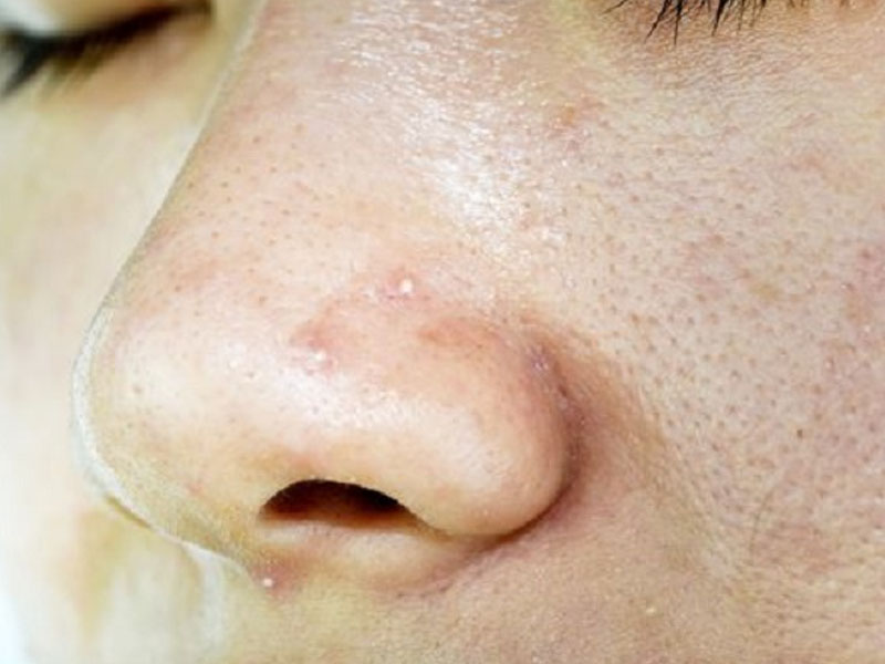 چرب شدن پوست بعد عمل بینی - دکتر بابک ساعدی