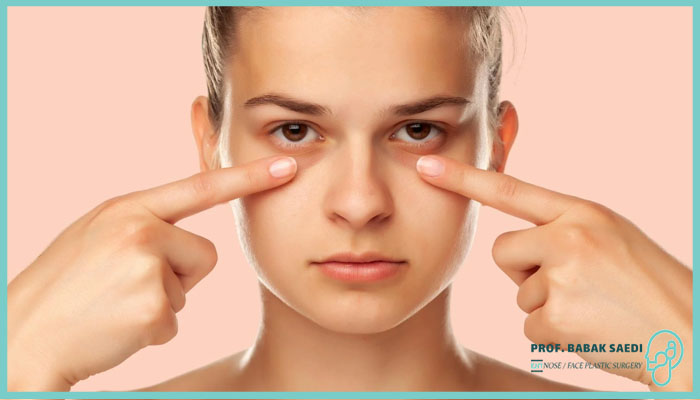 بهترین درمان گودی زیر چشم