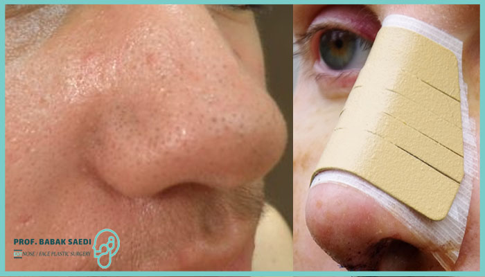 دلایل چرب شدن پوست بینی بعد از عمل