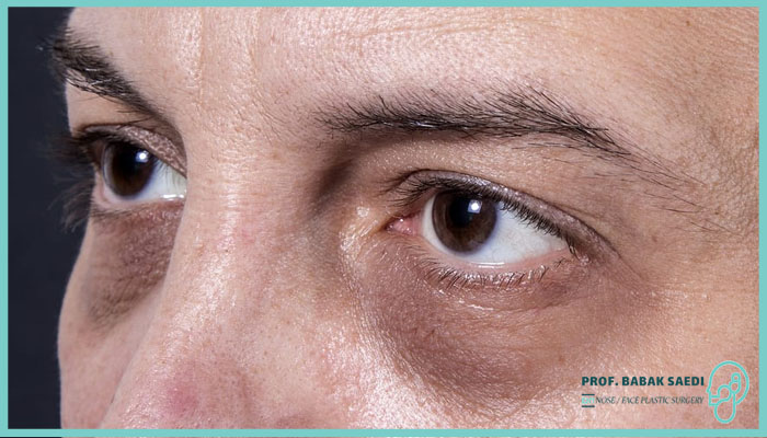 علل شایع ایجاد گودی زیر چشم