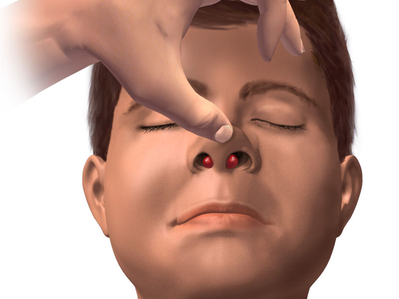 نکروز بینی بعد از عمل - دکتر بابک ساعدی