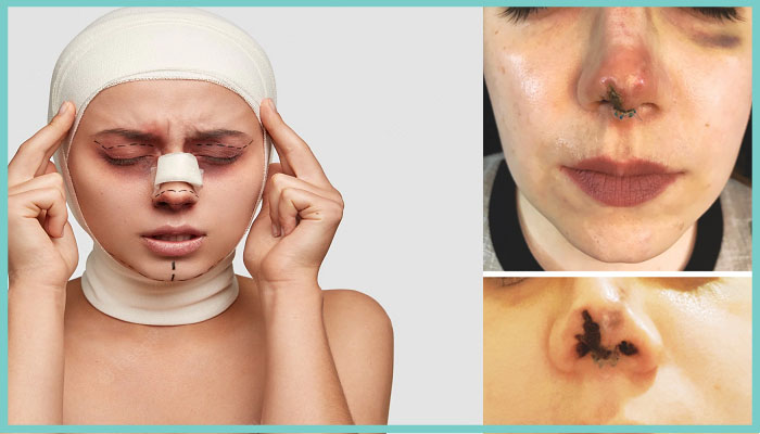 مدت زمان درمان نکروز بینی چقدر است؟