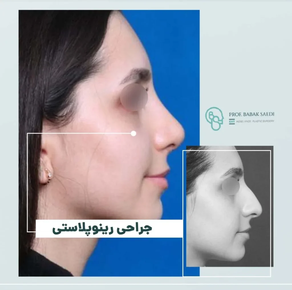 نمونه کار جراحی بینی دکتر بابک ساعدی