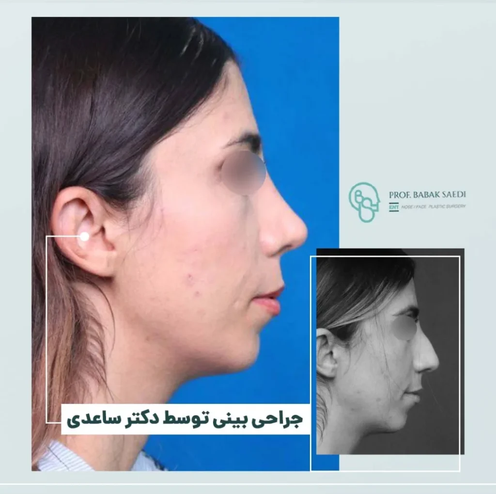 نمونه کار جراحی بینی دکتر بابک ساعدی