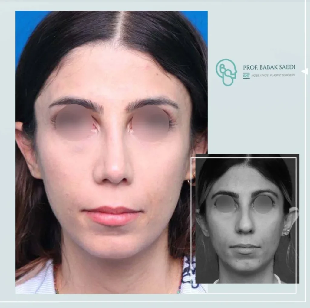 نمونه کار جراحی بینی دکتر بابک ساعدی